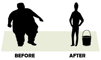 liposuction